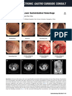 An Unusual Case of Lower Gastrointestinal Hemorrha