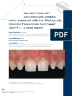 A New Veneer Technique With Prefabricated Composite Denture Teeth Combined With The "Biologically Oriented Preparation Technique" (BOPT) - A Case Report PDF