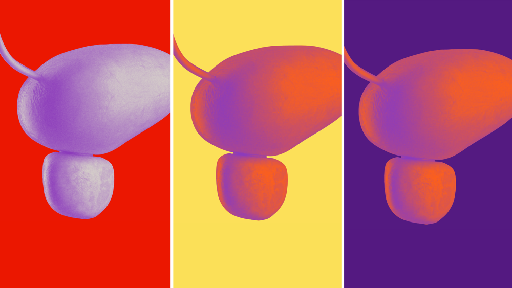 Illustration of three human bladders representing bladder cancer