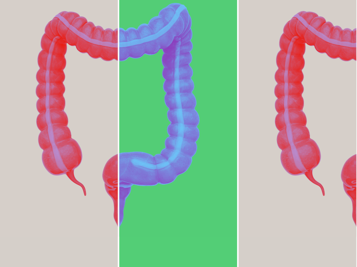 Illustration of two human colons representing gastrointestinal health conditions, including Inflammatory Bowel Disease (IBD) and Inflammatory Bowel Syndrome (IBS)