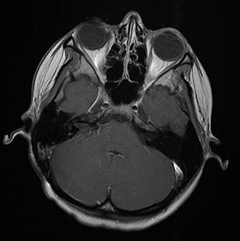 MRI, post-op