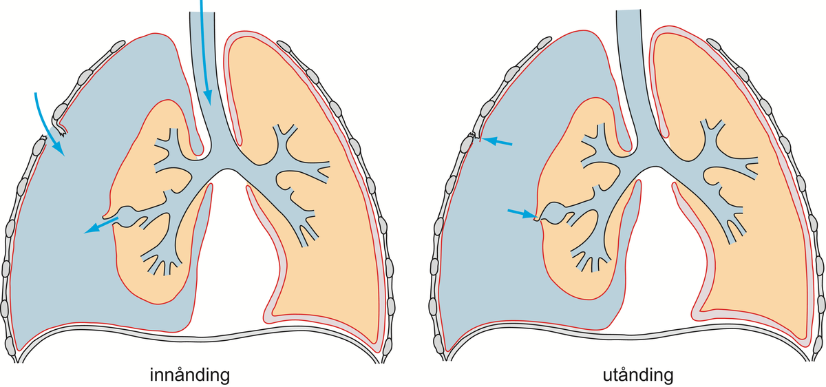 Pneumothorax.