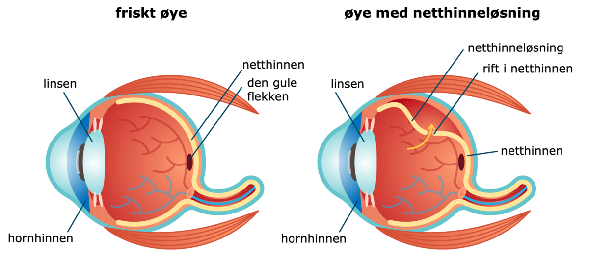 Netthinneløsning