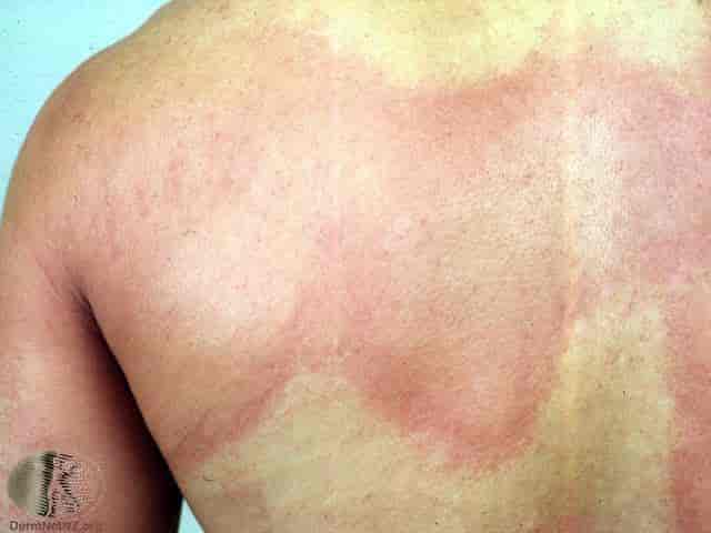 Urticaria