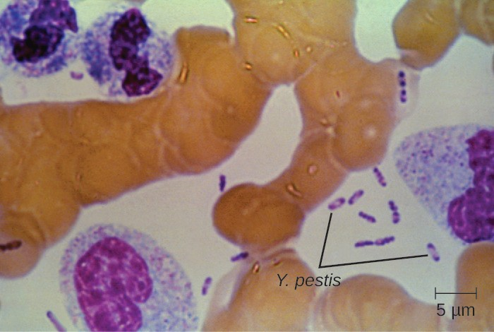 This Wright’s stain of a blood sample from a patient with plague shows the characteristic “safety pin” appearance of Yersinia pestis.