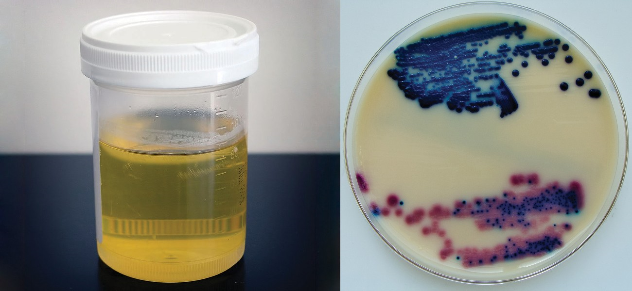 Many pathogens that cause infections of the urogenital system can be detected in urine samples (left). The top sample in the culture (right) was prepared from the urine of a patient with a urinary tract infection.