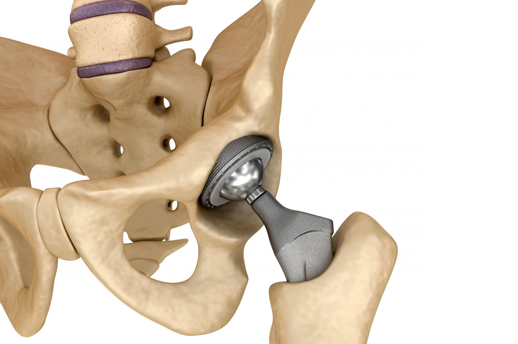 Zimmer протезы тазобедренного. Эндопротезирование тазобедренного сустава 3 д. Имплант тазобедренного сустава Титан. Гемипротез тазобедренного сустава. Имплантация эндопротеза тазобедренного сустава.
