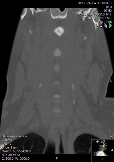 File:Computed tomographs of normal cervical vertebrae, coronal plane 39.jpg