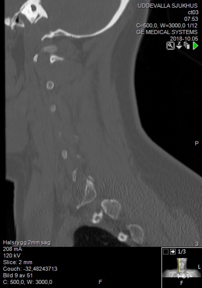 File:Computed tomographs of normal cervical vertebrae, sagittal plane 9.jpg