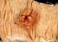 A colon polyp