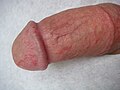Inflammation of the glans penis and the preputial mucosa