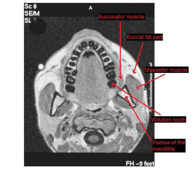 File:MRI showing masseter muscle and neighbors.png