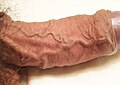 A semi erect penis with engorged dorsal veins and arteries, uncircumcised