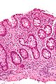 High mag. view of crypt branching (feature of chronic colitis).