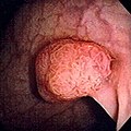 A colon polyp