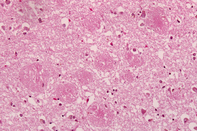 Амилоидные бляшки в мозге людей, погибших от болезни Альцгеймера