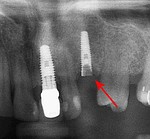 Fracture implant