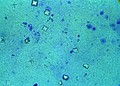 Urine microscopy showing calcium oxalate crystals in the urine. The octahedral crystal morphology is clearly visible.