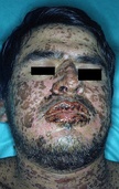 Person with Stevens–Johnson syndrome