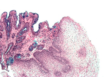 [Micrograph] of normal stratified squamous epithelium and the metaplasic epithelium of Barrett's esophagus (left of image). Alcian blue stain.