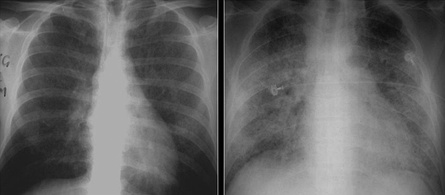 These chest radiographs are of two patients. Both show ground glass opacities. The left X-ray shows a much more subtle ground-glass appearance while the right X-ray shows a much more gross ground-glass appearance mimicking pulmonary edema.[7]