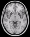 Horizontal slice of MRI-image showing the putamen. The other nuclei of the basal ganglia (caudate nucleus and globus pallidus) can be seen as well.