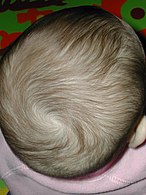 A hair whorl is a patch of hair growing in a circular direction around a visible center point.