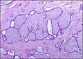 Histopathologic image of breast fibroadenoma showing proliferation of intralobular stroma compressing and distorting the epithelium. H&E stain.