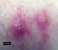 Chigger bites on human skin showing characteristic welts