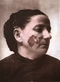 Lupus vulgaris in a woman, late 19th century