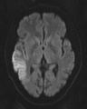 DWI showing cortical ribbon-like high signal consistent with diffusion restriction in a patient with known MELAS syndrome