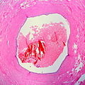 Endometriosis of the Fallopian Tube, an example of tubal occlusion