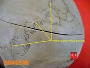 Wormian bones at lambdoid suture