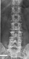 Lumbarization of sacral vertebra 1, seen as 6 vertebrae that do not connect to ribs.