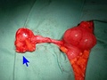 Mucinous adenocarcinoma of the appendix tip