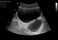 Diverticulum of the urinary bladder of a 59-year-old man, transverse plane