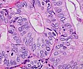 Nuclear grade 1: Oval, mildly enlarged nucleus with evenly distributed chromatin.[63]