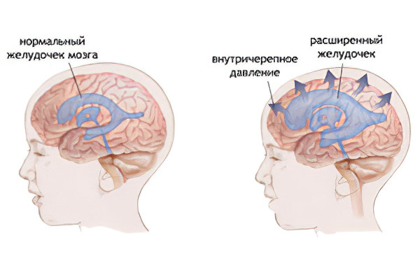 Внутричерепное давление