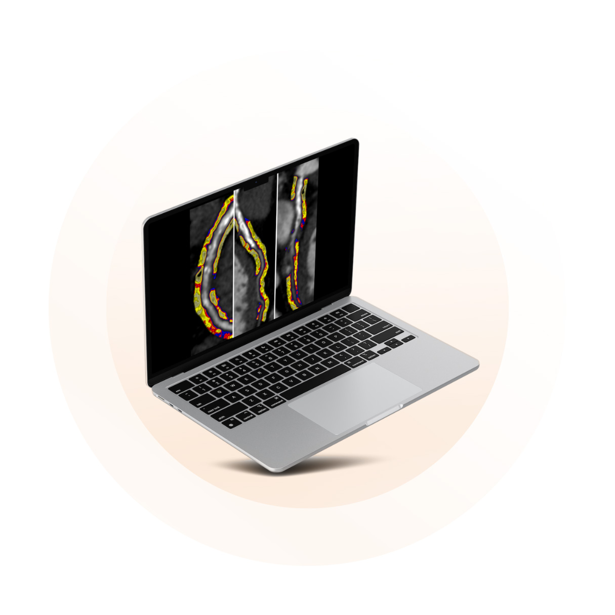 CaRi-Heart Technology shown on a laptop
