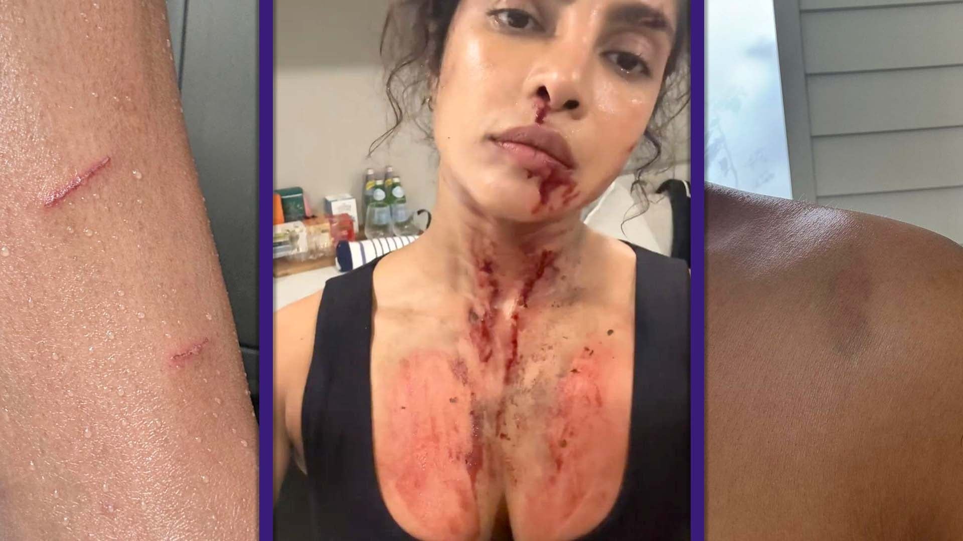 Priyanka Chopra Shows Off Real Battle Scars While Filming Bloody Action Movie