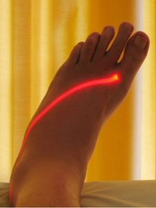 Laser Theraphy