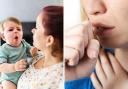 Whooping cough (pertussis), also known as the 100-day cough, is a bacterial infection of the lungs