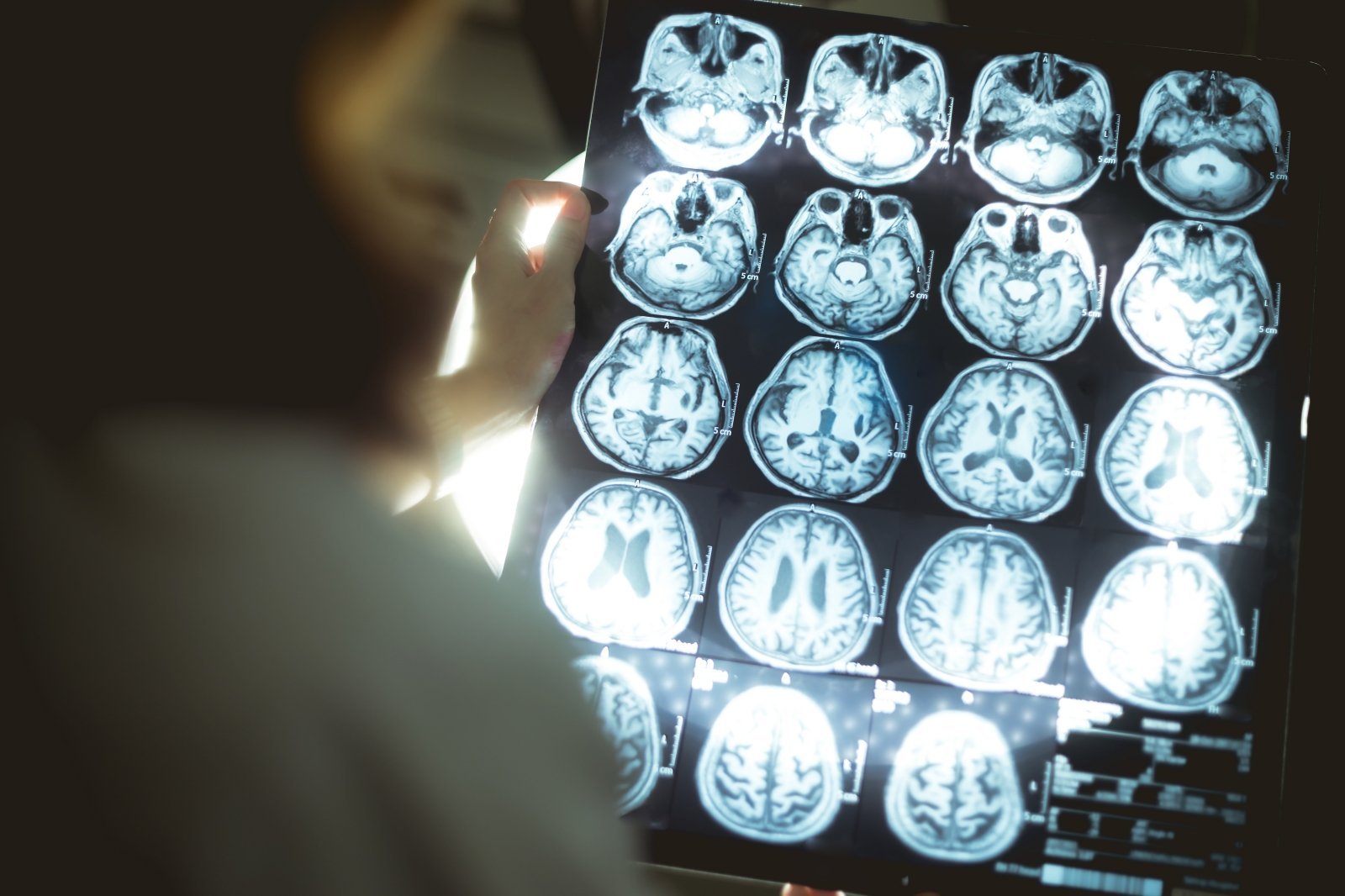 Naujas tyrimas parodė, kokie 3 veiksniai smarkiai veikia pažeidžiamiausią smegenų sritį ir skatina demenciją