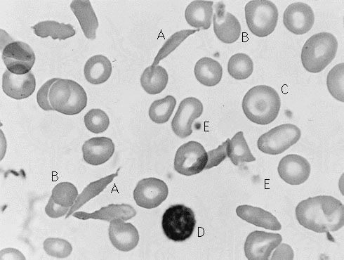 blood smear showing sickle cell anemia