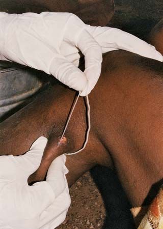 guinea worm disease