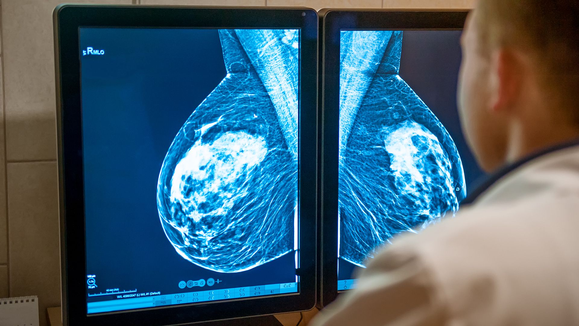 Learn how breast cancer is detected using Magnetic resonance mammography