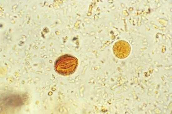 amebiasis: Entamoeba hystolytica