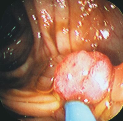 precancerous growth in a human colon