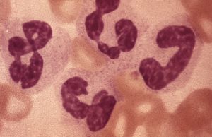 leukocytosis