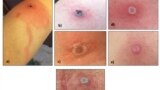 This image provided by the Alaska Department of Health shows several Alaskapox lesions. (Alaska Department of Health via AP)